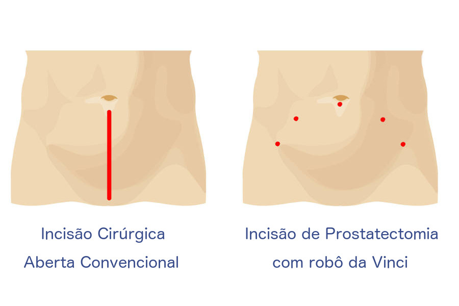 prostatectomia-robotica-2